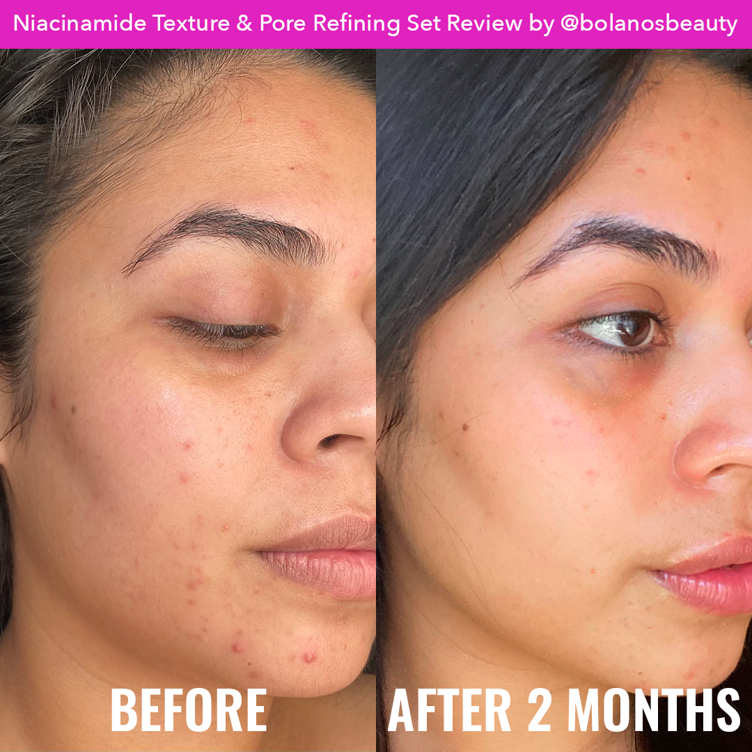 Niacinamide Texture & Pore Refining Set